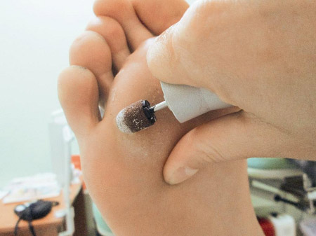 Kak-lechit-suhie-mozoli-na-nogah