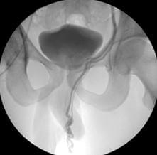 Кавернозогр