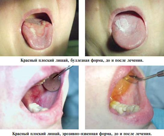 Симптомы атипичных форм