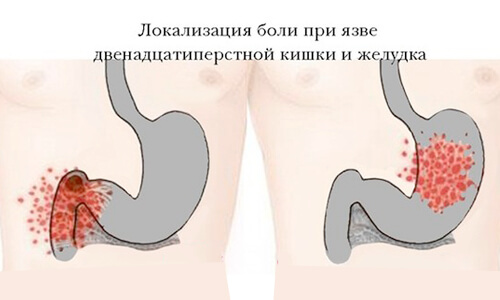 lokalizacija-boli-pri-jazve