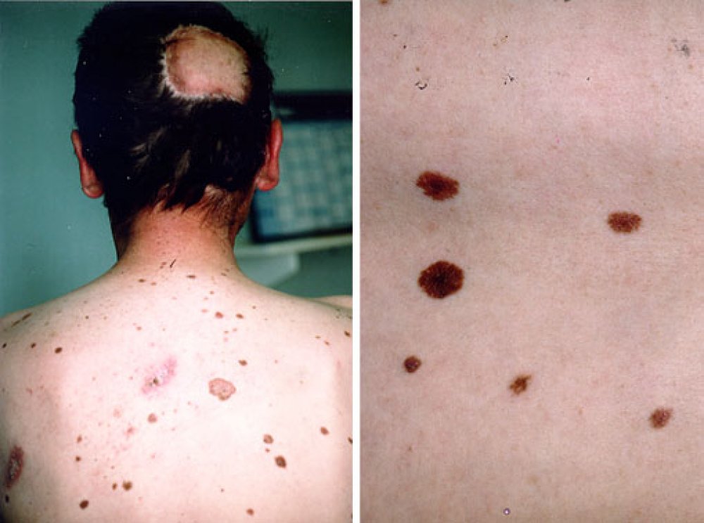 Malignant-Moles-Pictures-3