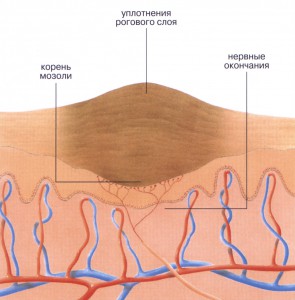 Лечение мозоли на ногах