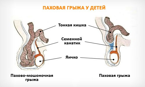 Pahovaja-gryzha-u-detej1