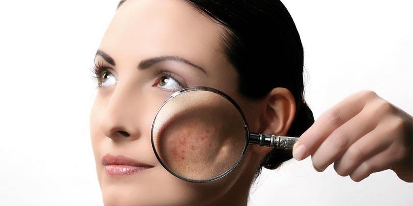 Лечение себорейного дерматита