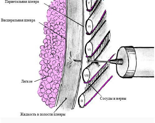 Shema-plevralnoj-punkcii