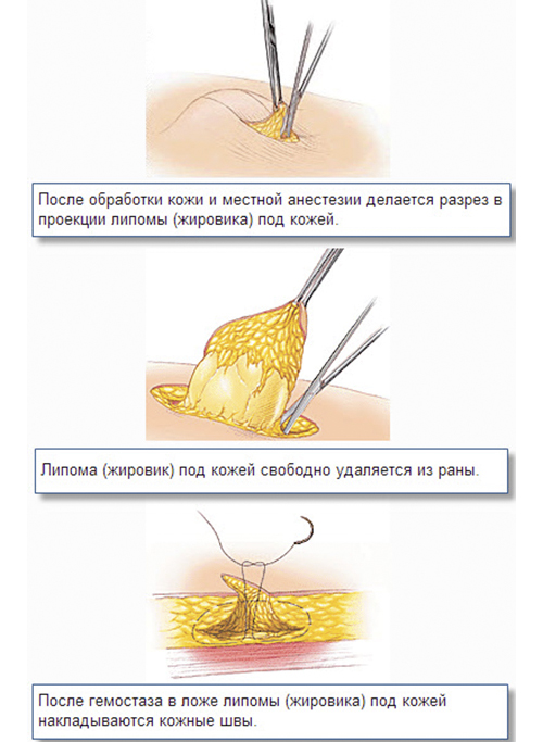 Shema-udalenija-lipomy