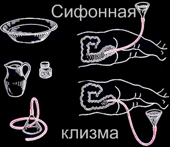 Sifonnaya-klizma