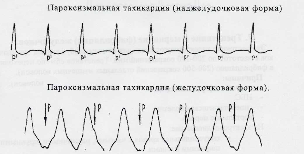 пароксизмальная тахикардия