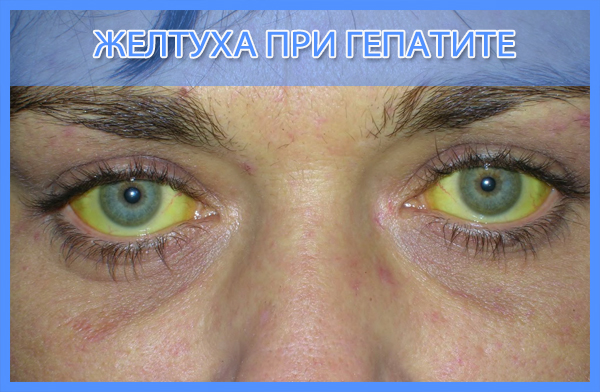 Желтушный период