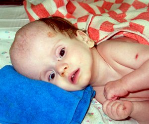 признаки водянки головного мозга