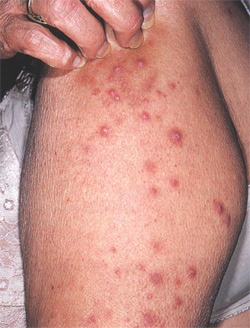 Почесуха взрослых