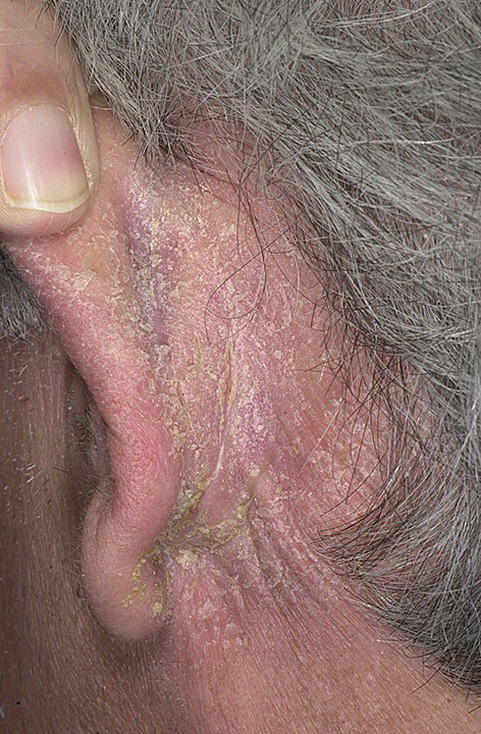 Воспалительный тип