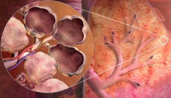 Причины возникновения эмфиземы легких