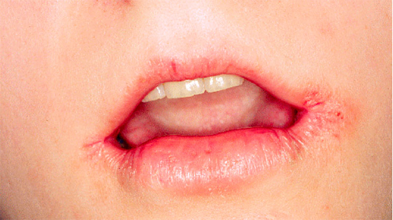 chem-lechit-zaedy-u-rebenka3