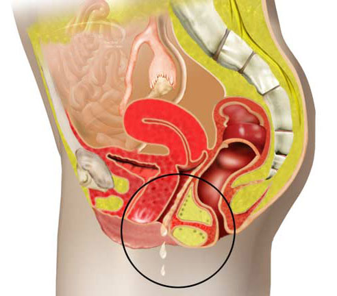 Симптомы молочницы