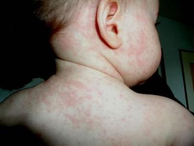 энтеровирусной экзантемы