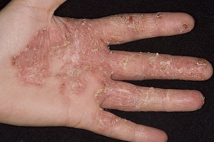 disgidroz_kistej_611