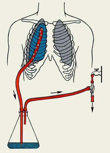 drenirovanie-plevralnoy-polosti