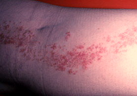 бородавчатый эпидермальный невус