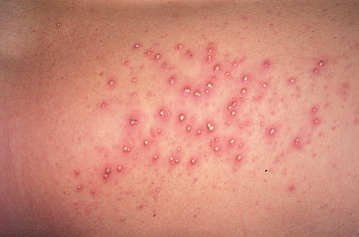 follikulit-gramnegativnyj-foto-02