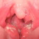 foto-gerpesnoj-anginy