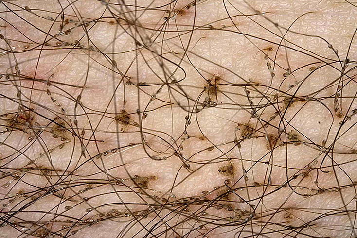 foto-gnid-na-volosah