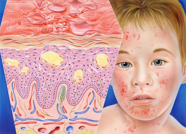 Симптомы аллергического дерматита