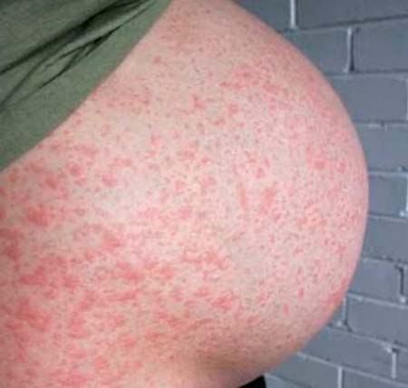 gemorragicheskaya-syp-u-beremennyx