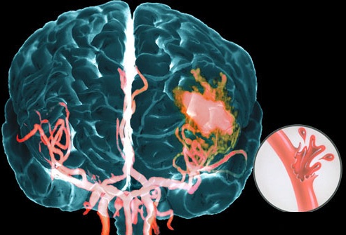 gemorragiheskiy-insult