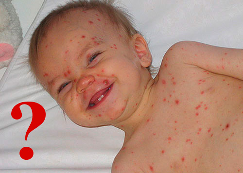 Герпес 6 типа у детей