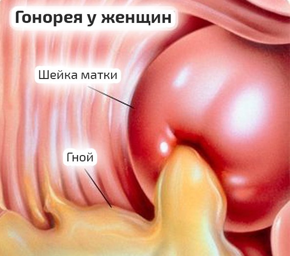 gonoreya-u-zhenshchin