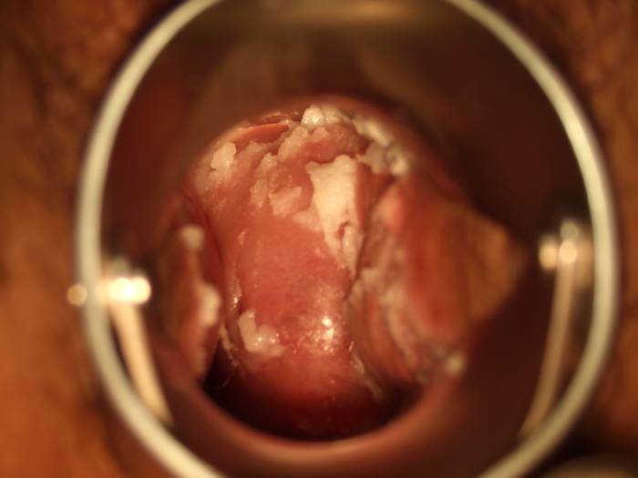 Диагностика молочницы