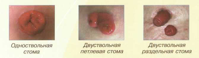 stoma