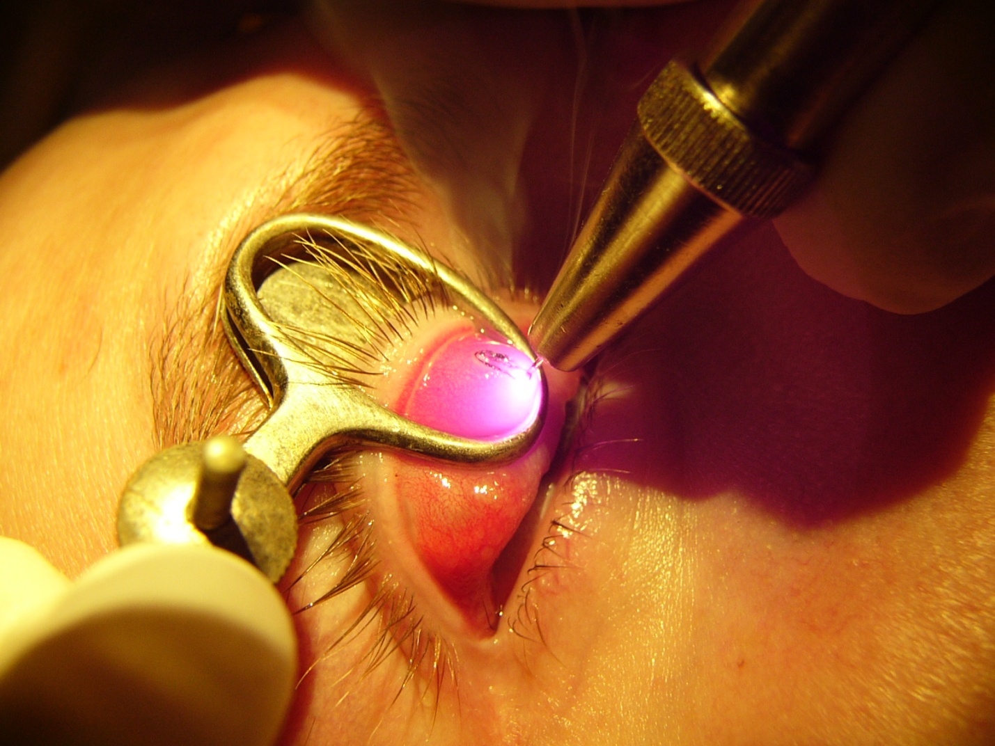 Лечение халязиона лазером