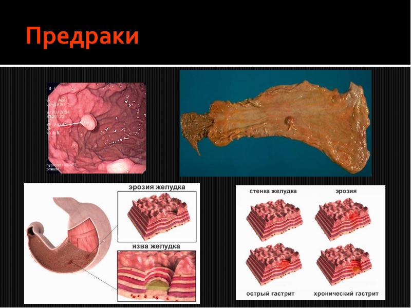 метаплазия стенок желудка.