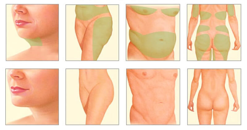 inekczionnaya-liposakcziya