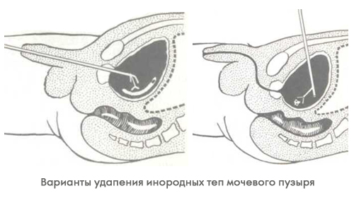 Лечение пациентов при попадании в мочевой пузырь инородных предметов
