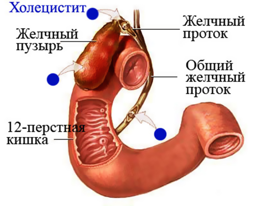 kholetsistit-lechenie-narodnymi-sredstvami