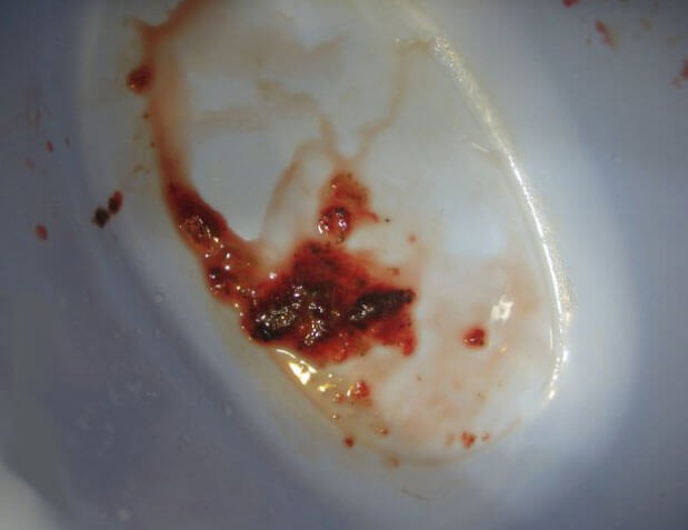 krov-v-kale-u-rebenka