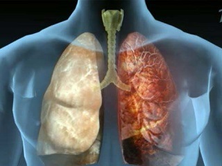 Муковисцидоз