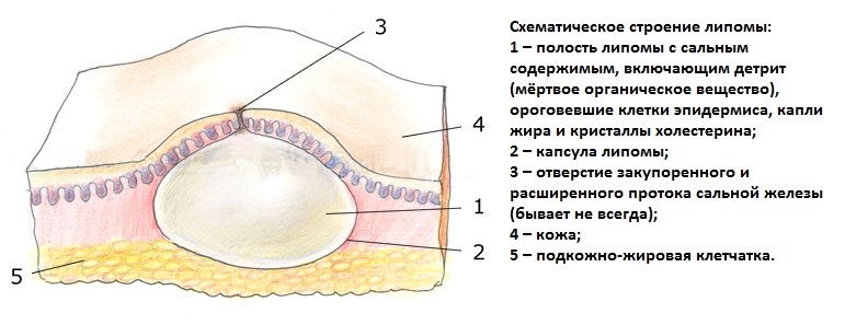 lipoma1