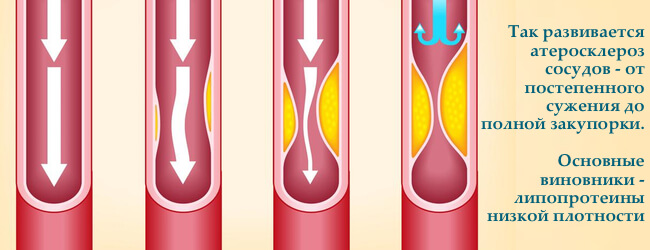 lipoproteiny-nizkoj-plotnosti-oxoj-xolesterol