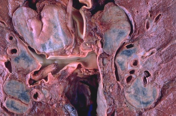 lyogkie-pri-sarkoidoze