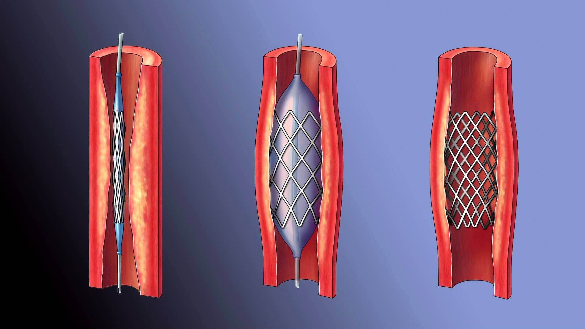 шунтирование сердца