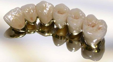 metallokeramicheskie_koronki