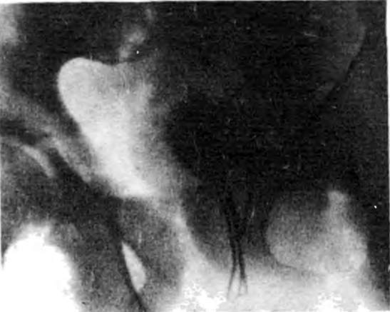 Как чужеродные тела проникают в мочевой пузырь?