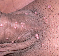 Контагиозный моллюск