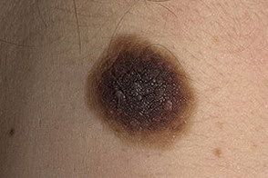 Пограничный невус