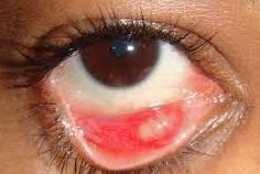 Как выявить халязион