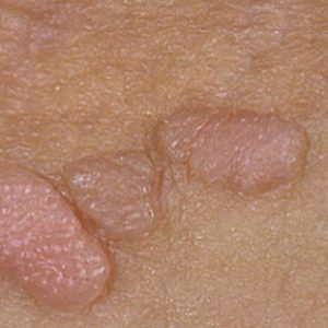 papillom-na-intimnyh-mestah